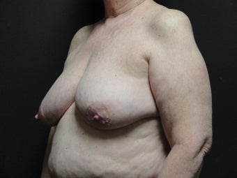 Breast reconstruction - Implants 912574