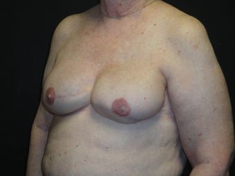 Breast reconstruction - Implants 912574