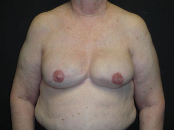 Breast reconstruction - Implants after 912574