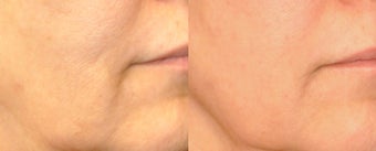 Skin rejuvenation with Sublative and ePrime combination treatment before 1098905