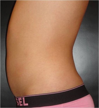 SmartLipo MPX after 686056