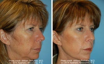 Facelift before 91467