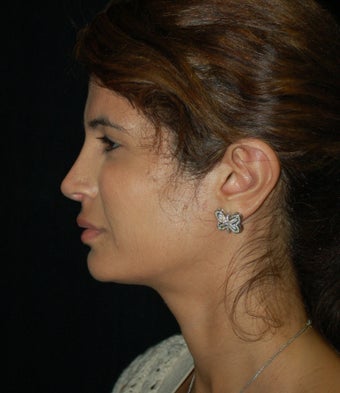 Revision Rhinoplasty after 392821