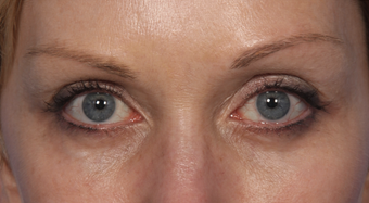 Eyelid Surgery after 310159