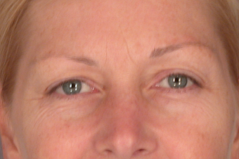 Eyelid Surgery before 310159