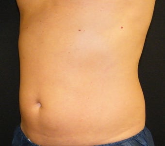 CoolSculpting 622014