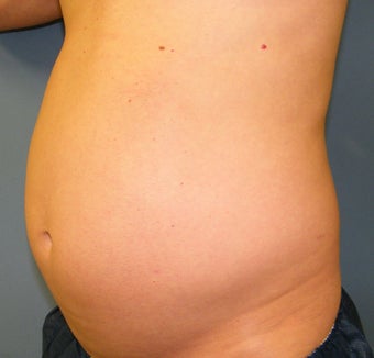 CoolSculpting 622014