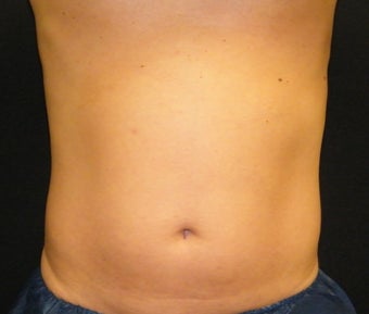 CoolSculpting after 622014