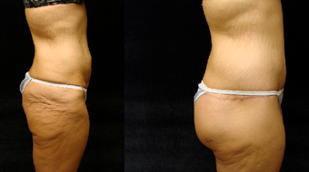 Lower Body Lift before 1248529