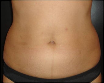 SmartLipo MPX before 686094