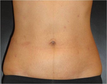 SmartLipo MPX after 686094