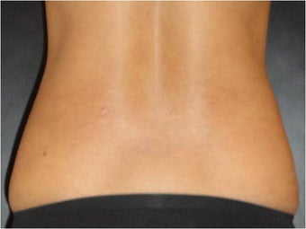 SmartLipo MPX 686094