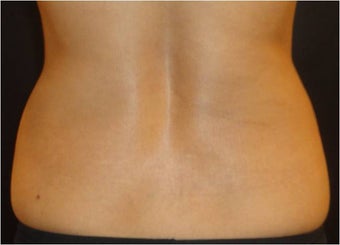 SmartLipo MPX 686094