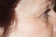 Botox before 748933