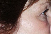 Botox after 748933