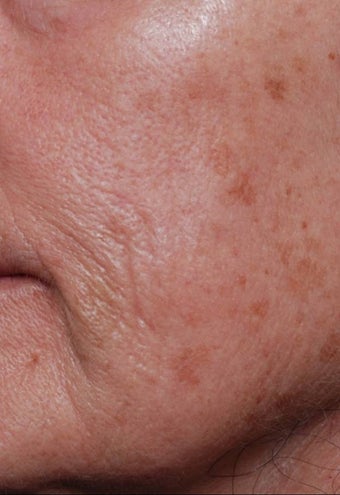 Female treated for Sunspots/Photoaging before 772029
