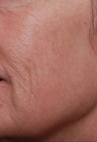 Female treated for Sunspots/Photoaging after 772029