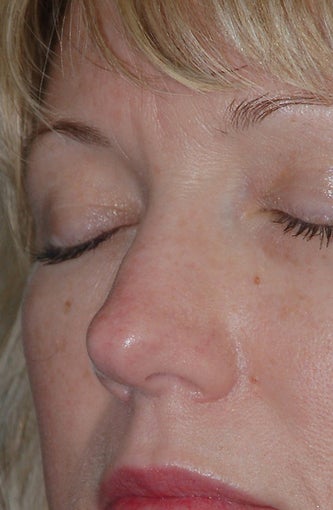 Non-Surgical Rhinoplasty after 182607