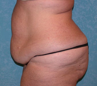 Circumferential Body Lift before 856577