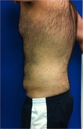 Laser Lipo after 333249
