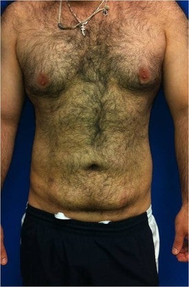 Laser Lipo 333249