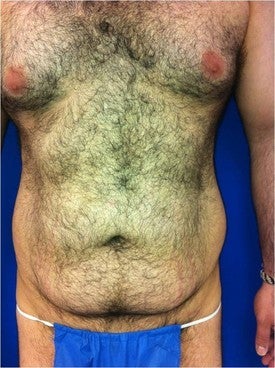 Laser Lipo 333249