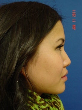 Rhinoplasty 393363
