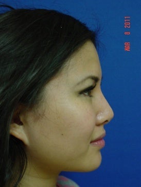 Rhinoplasty 393363