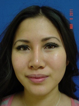 Rhinoplasty after 393363