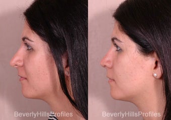 Revision Rhinoplasty before 681876