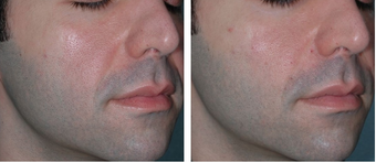 Young Male Treated for Nasolabial Folds and Cheek Volume before 1367276