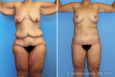 Body Lift before 216783