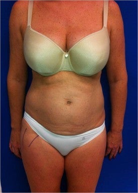 Laser Lipo 333251