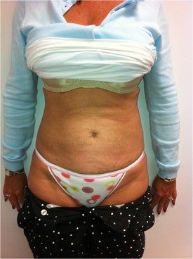 Laser Lipo 333251