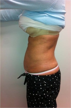 Laser Lipo after 333251