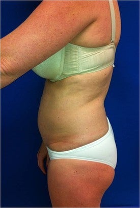 Laser Lipo before 333251