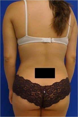 Laser Liposuction 561192