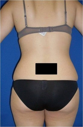 Laser Liposuction 561192