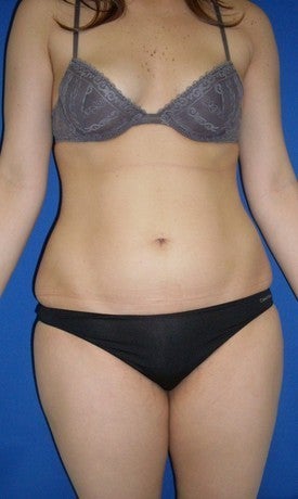 Laser Liposuction before 561192