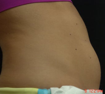 Coolsculpting before 570564