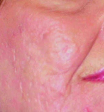 Fraxel Laser Acne Scars after 901955