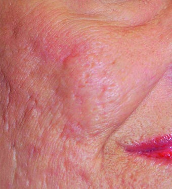 Fraxel Laser Acne Scars before 901955