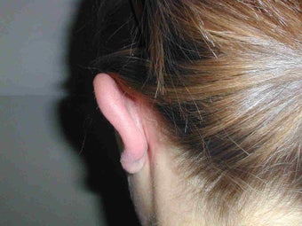 One ear Otoplasty after 108818