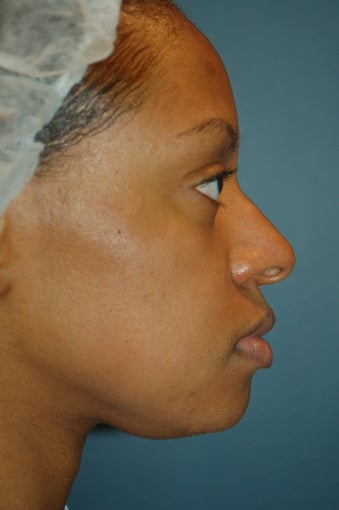 Nose Surgery before 928997