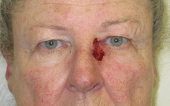 Eyelid and cheek basal cell carcinoma before 875949
