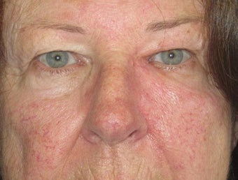 Eyelid and cheek basal cell carcinoma after 875949