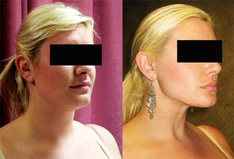 neck liposuction before 232502