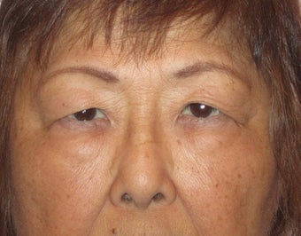 64 year old female who desired double lid surgery before 811454