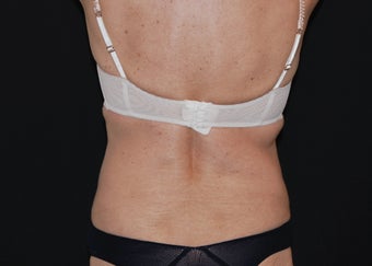CoolSculpting 5 after 941170