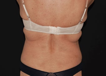 CoolSculpting 5 before 941170